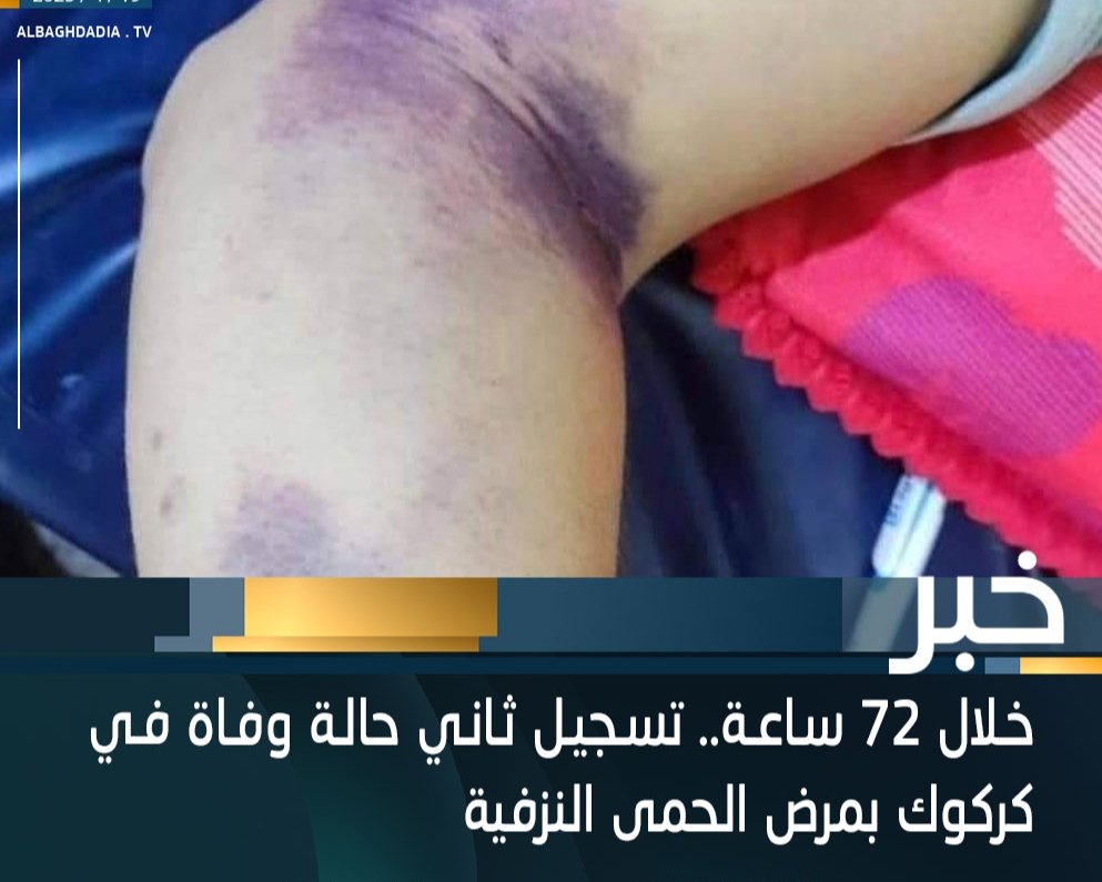 خلال 72ساعة
تسجيل ثاني حالة وفاة في كركوك 
بمرض #الحمى_النزفية