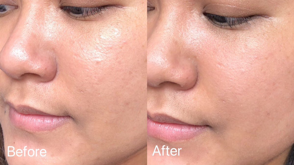 อีกหนึ่งโฟมที่ชอบใช้มาตลอด Mentholatum Acnes Clear &amp; Whitening Wash สูตรนี้ลดสิว ลดรอย ช่วยให้ผิวกระจ่างใส ไม่มีสารสบู่ อ่อนโยนต่อผิวด้วย หลังล้างหน้าสะอาด แต่ไม่เอี๊ยดไม่เเห้งตึง ราคานักเรียนสุดๆหาซื้อได้ตาม 7-11 เลยย✨
พิกัดออนไลน์ https://t.co/Y8uaCpJpWp https://t.co/pCVIz4U39Y