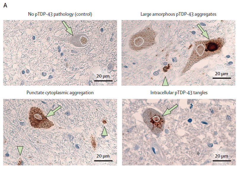 Genetic mutations contribute to a small but significant portion of Amyotrophic lateral sclerosis (ALS) cases.

A new <a href="/TheLancetNeuro/">The Lancet Neurology</a> Series summarises groundbreaking research on genetic ALS, offering insights into potential treatments: hubs.li/Q03hD_pc0
