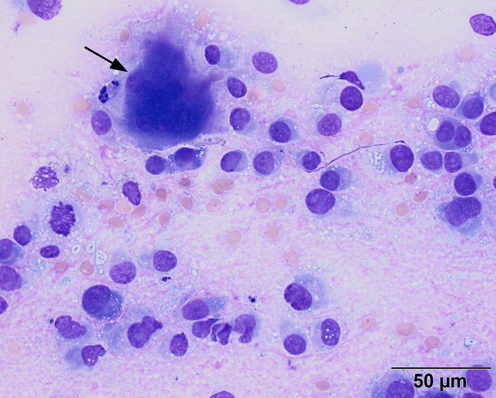 Last image from the aspirate of the chondrosarcoma in a rib of a dog: The arrowed cell is an osteoclast, indicating osteolysis.