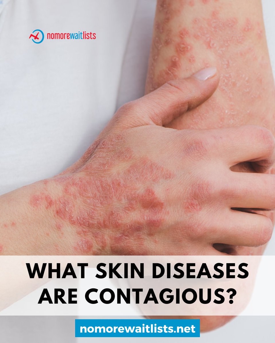 🤒 What skin diseases are contagious? Impetigo, scabies, warts &amp; more can spread fast through contact or surfaces.

🧼 Stay clean, don’t share personal items, and seek timely care.

🇨🇦 Find trusted providers fast at NoMoreWaitLists.net

#SkinHealth #NoMoreWaitLists