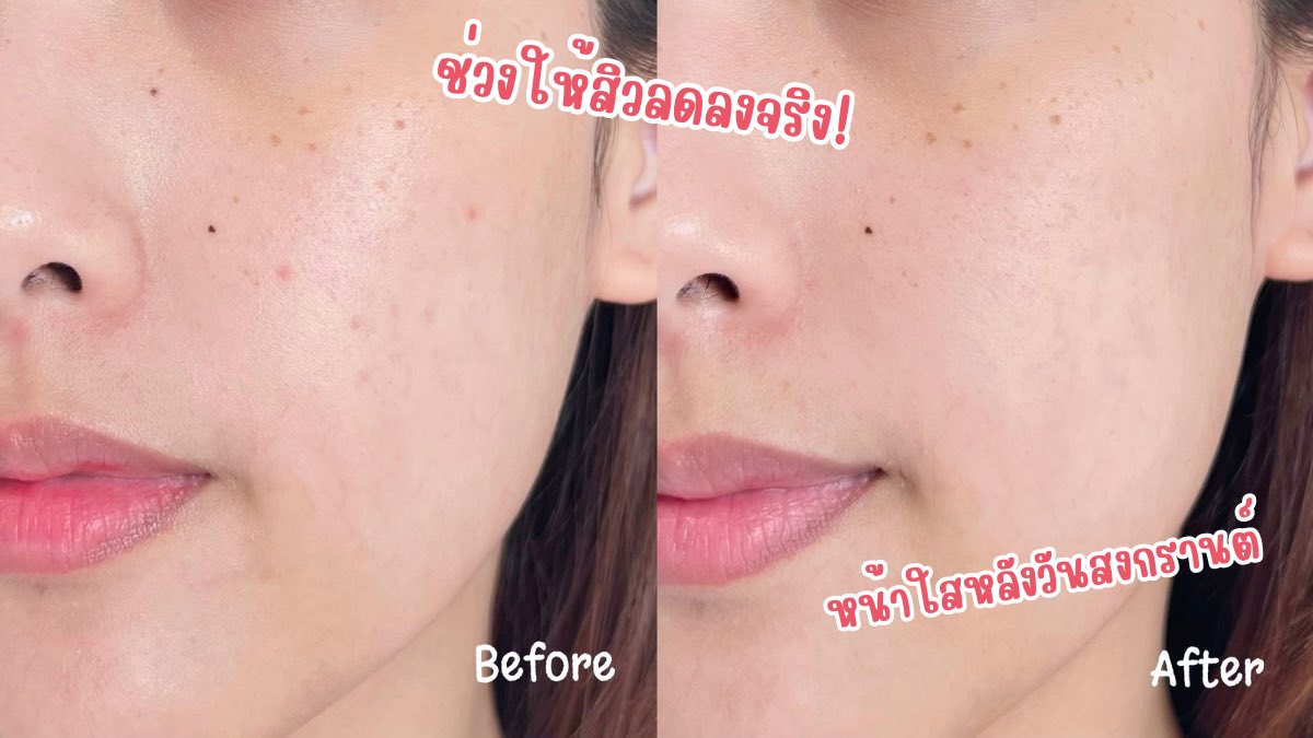 ใครอยากหาไอเทมช่วยให้หน้าใส ไร้สิว หลังวันสงกรานต์ มากินนี่ด่วนๆ Jelly Me ZinC น้องเจลลี่ลดสิว เนื้อเจลลี่นุ่มเด้ง อร่อยมากกก หอมกลิ่นพีช ที่สำคัญคือน้ำตาล 0% นี่กินต่อเนื่องมาสักพักละ น้องจะช่วยให้สิวลดลง หน้าใสขึ้นจริง ซองละ 20-. พิกัด 7-11🍑

#JellyMeCuti #ความคิวทิบิลด์ง่ายได้ทุกวัน #JellyMeZinc #ลดสิว #ดีบอกต่อ