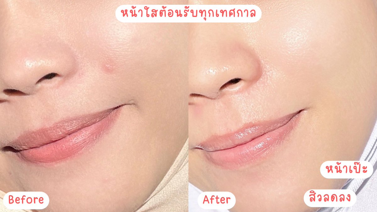 หลังสงกรานต์ กู้ผิวใสไร้สิวง่ายๆ! 

ฮาโหลลล~ ใครผิวหน้า มีปัญหา เตรียมตัวให้พร้อมก่อนลุยด้วย Jelly Me
ZinC เจลลีลดสิว อร่อย กลินหอม สดชื่น กินง่าย ไม่กลัว สิวขึ้นก่อนช่วงเทศกาลนี้จัดเลยย 
  
#JellyMe #JellyMeCuti #ความคิวทิบิลด์ง่ายได้ทุกวัน
#JellyMeZinc #ลดสิว #HowtoPerfect https://t.co/3Xph4aUYcS