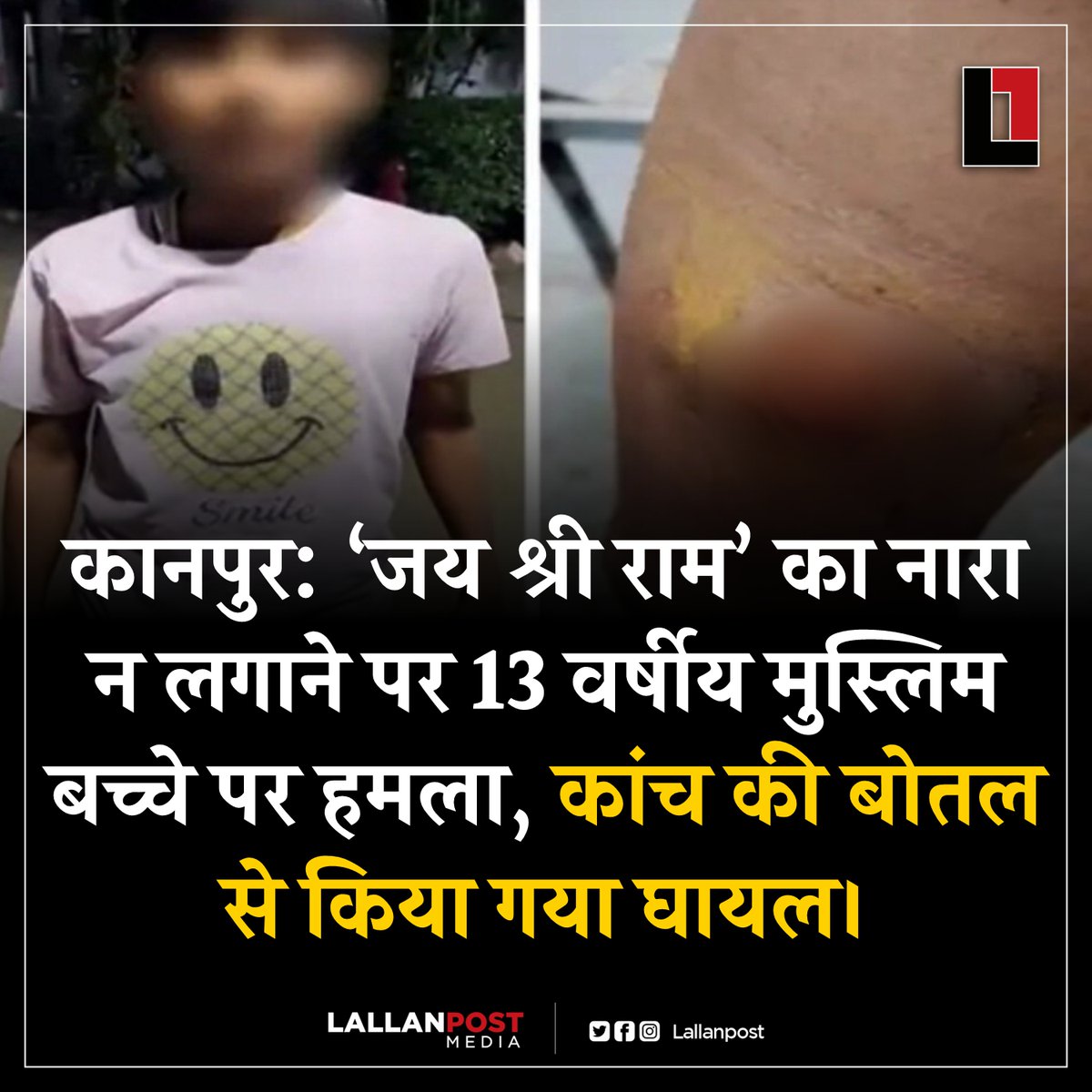 Lallanpost's tweet photo. कानपुर: ‘जय श्री राम’ का नारा न लगाने पर 13 वर्षीय मुस्लिम बच्चे पर हमला, कांच की बोतल से किया गया घायल। https://t.co/zJe7Pxy7lJ