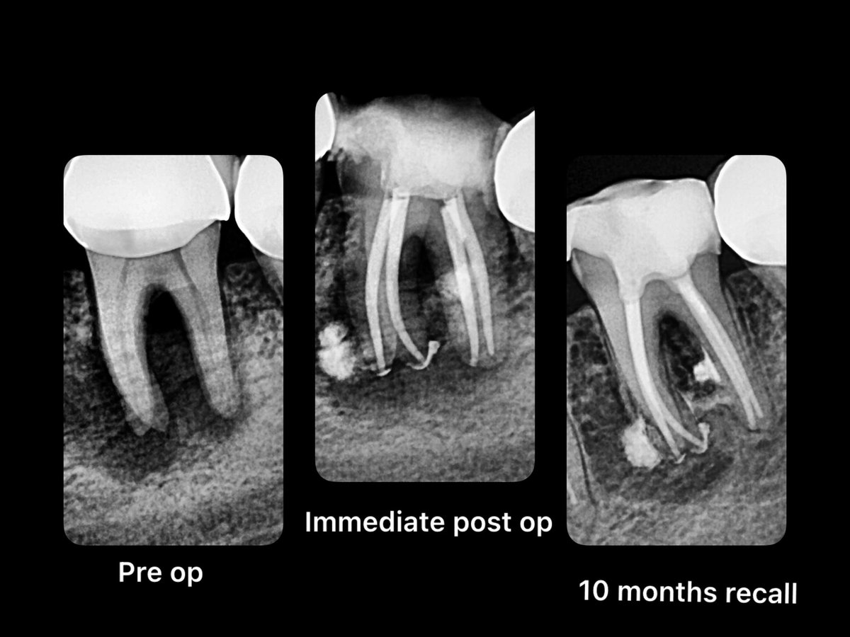 iNash__'s tweet photo. Endodontics saves many teeth from extraction. This tooth had grade iii mobility and was doomed hopeless , 10 months follow up radiography a favorable healing is evident , #endo #endowarrior #rct #dentistry #dentistryworld #Abha

https://t.co/LKgNx9hXuK https://t.co/PPbsglYqoP
