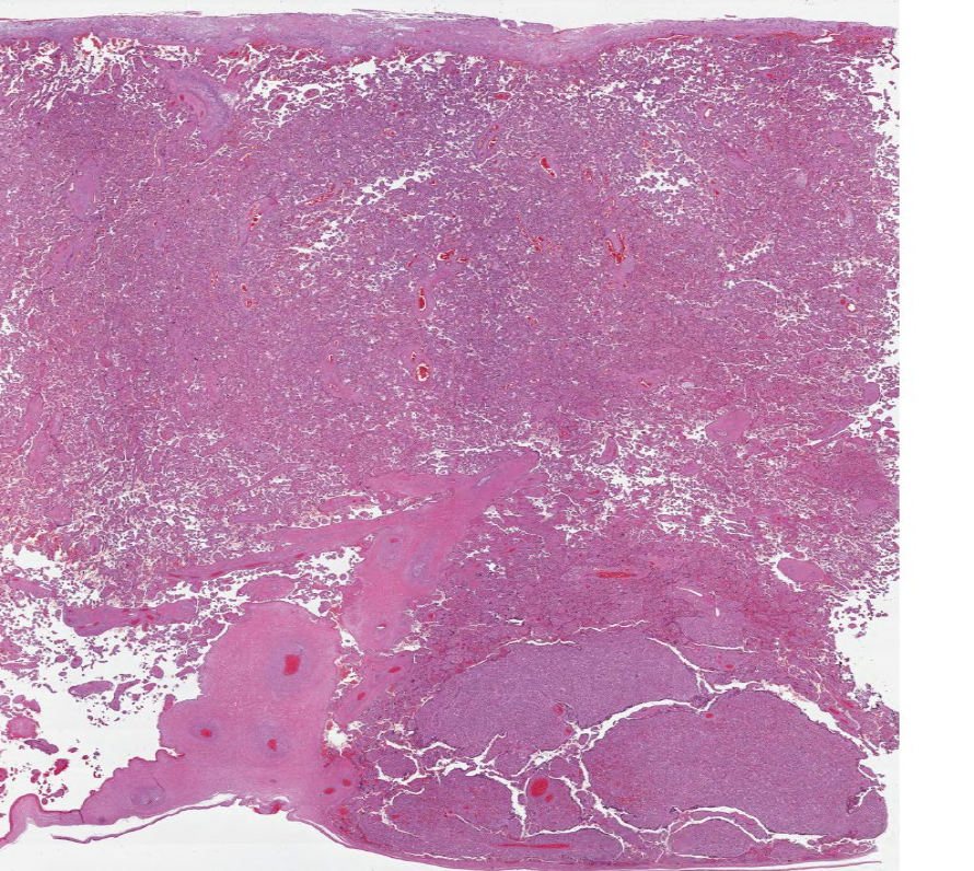 Path4People's tweet image. You gross 🔪 a placenta 🩸 

And you find this incidental lesion

Is it a

Chorangioma
Chorangiomatosis 
OR
Chorangiosis ?😵‍💫 

#pedipath #peds #pathx  #placenta #obgyn