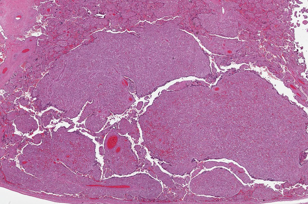 Path4People's tweet image. You gross 🔪 a placenta 🩸 

And you find this incidental lesion

Is it a

Chorangioma
Chorangiomatosis 
OR
Chorangiosis ?😵‍💫 

#pedipath #peds #pathx  #placenta #obgyn