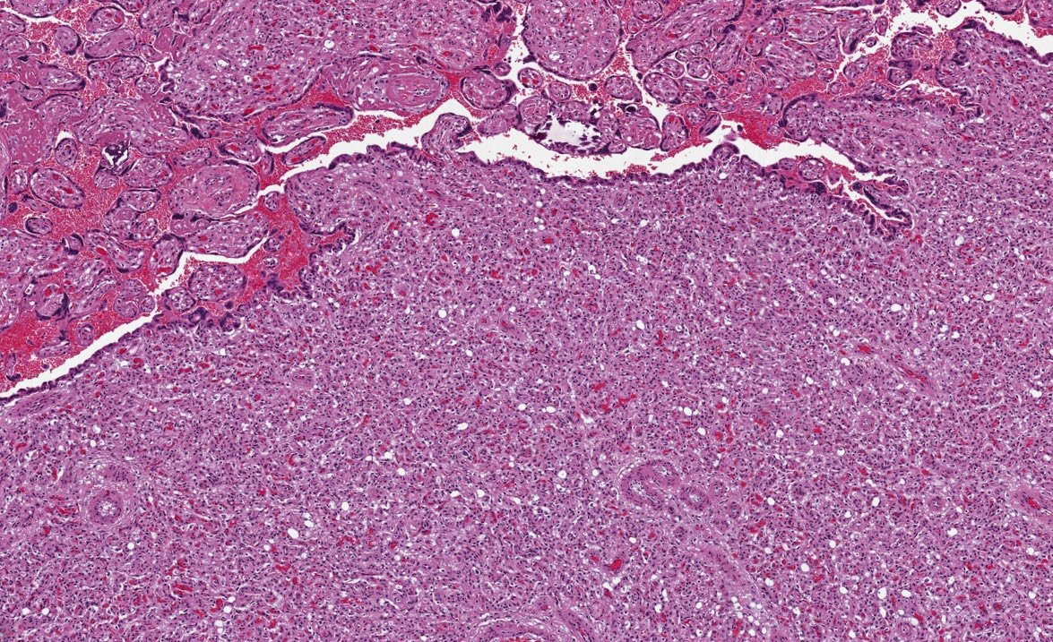 Path4People's tweet image. You gross 🔪 a placenta 🩸 

And you find this incidental lesion

Is it a

Chorangioma
Chorangiomatosis 
OR
Chorangiosis ?😵‍💫 

#pedipath #peds #pathx  #placenta #obgyn