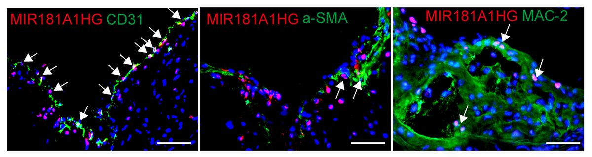 CircRes's tweet photo. Ni & colleagues found the #LncRNA #MIR181A1HG accelerated #atherosclerosis progression by enhancing endothelial #inflammation & promoting #monocyte recruitment. Learn more at https://t.co/U35oF2jZO4 https://t.co/JO9gzvj0Mq