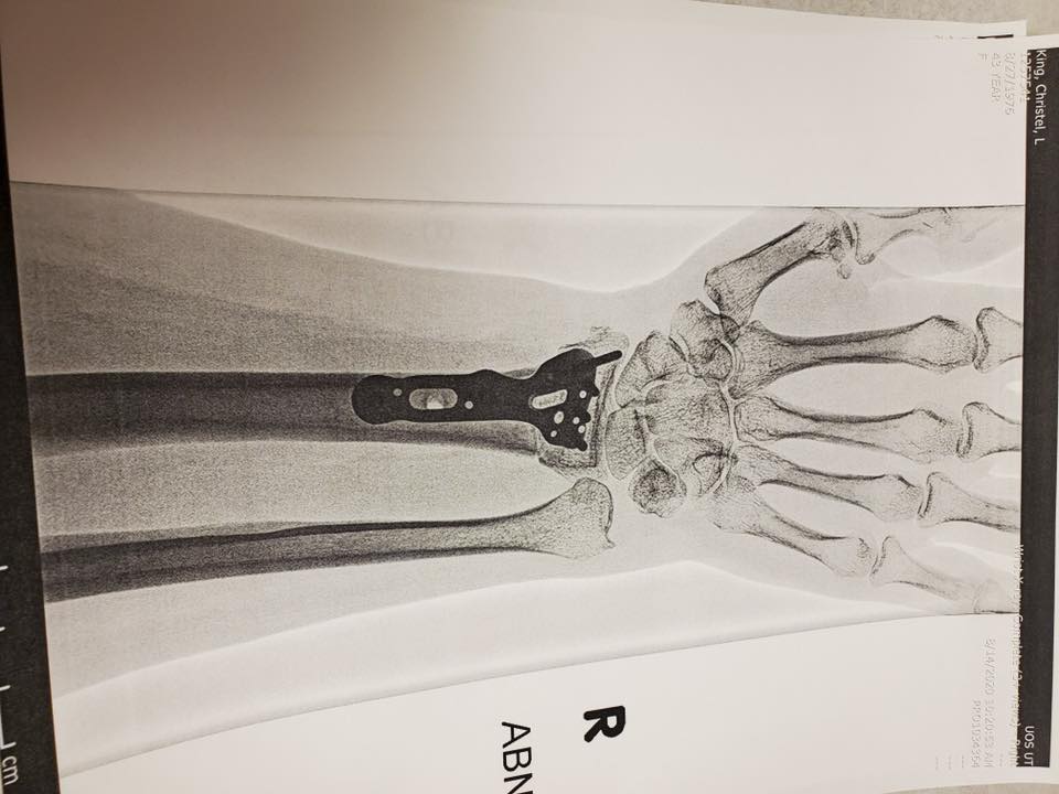 CombatingAutism's tweet photo. Severe Autism:
"My son giving me four concussions and broken my arm, requiring hardware and a re-break twice." - Christel Lynn King https://t.co/7oKWQaPo6t