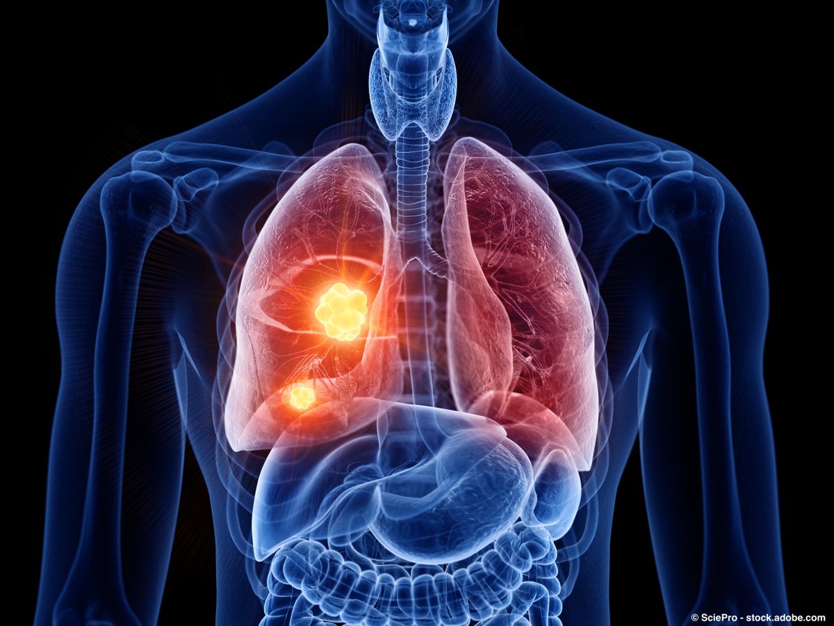 OncLive.com (@onclive) on Twitter photo At a data cutoff date of August 23, 2024, adagrasib/pembrolizumab elicited an ORR of 59% in patients KRAS G12Cāmutated #NSCLC, which included:
- CRs (57%)
- SD (22%)
- PD (4%)
#ELCC25 <a href="/marinagarassino/">Marina Garassino</a> <a href="/UChicago/">The University of Chicago</a>
Read for more data:
hubs.li/Q03hHqJj0 At a data cutoff date of August 23, 2024, adagrasib/pembrolizumab elicited an ORR of 59% in patients KRAS G12Cāmutated #NSCLC, which included:
- CRs (57%)
- SD (22%)
- PD (4%)
#ELCC25 <a href="/marinagarassino/">Marina Garassino</a> <a href="/UChicago/">The University of Chicago</a>
Read for more data:
hubs.li/Q03hHqJj0