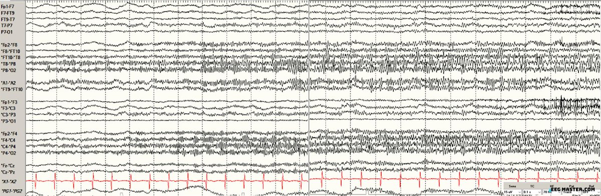 Based on the EEG findings in this right-handed patient with focal-onset seizures, what is the least likely seizure semiology? Click on this link to view the options, submit your answer and see explanation. eegmaster.com/eegmaster/quiz…