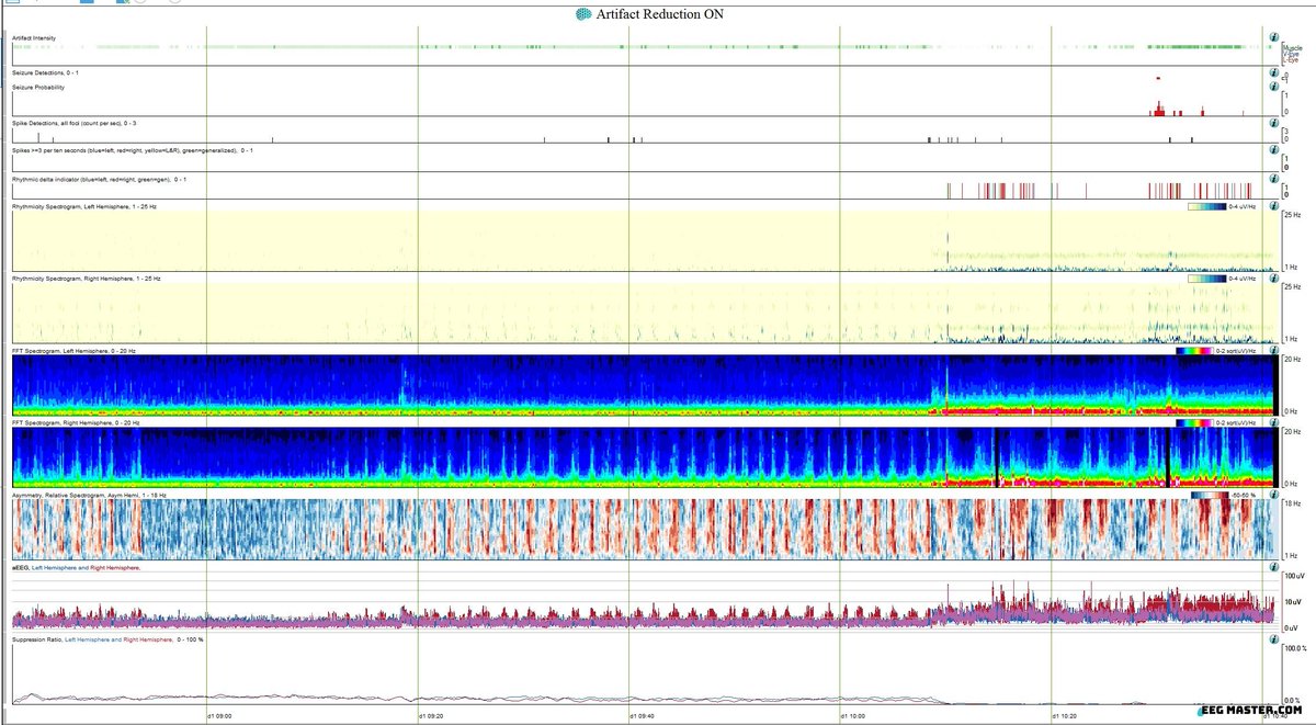 Which QEEG spectrogram is the most sensitive for detecting focal onset seizures that do not have a bilateral spread pattern on raw EEG? Click on this link to view the options, submit your answer and see explanation. eegmaster.com/eegmaster/quiz…