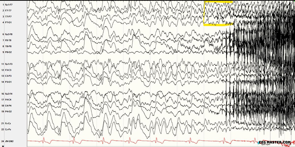 A patient being evaluated for seizures has a seizure during sleep shown below. Which of the following is correct regarding the electrographic seizure seen in this EEG epoch? Click on this link to view the options, submit your answer and see explanation. eegmaster.com/eegmaster/quiz…
