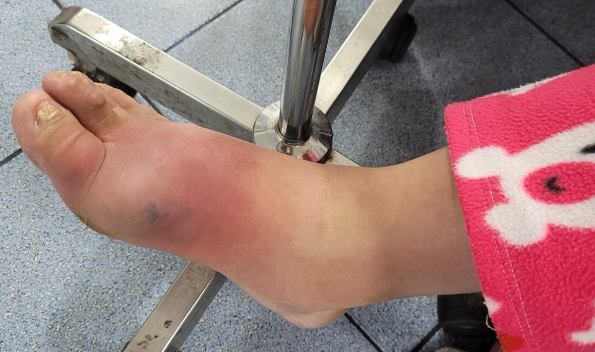 ConsejosReumato's tweet photo. Mujer con #lupus quien recibe #prednisona y #micofenolato , desarrolló #celulares del dorso del pie y #artritis de 1ra MTF, la #artrocentesis mostró LS turbio con gran cantidad de PMN, en el cultivo se aisló S. aureus; mejoró con antibióticos y drenaje quirúrgico.#podagra #sle https://t.co/ZPFJZeMntY