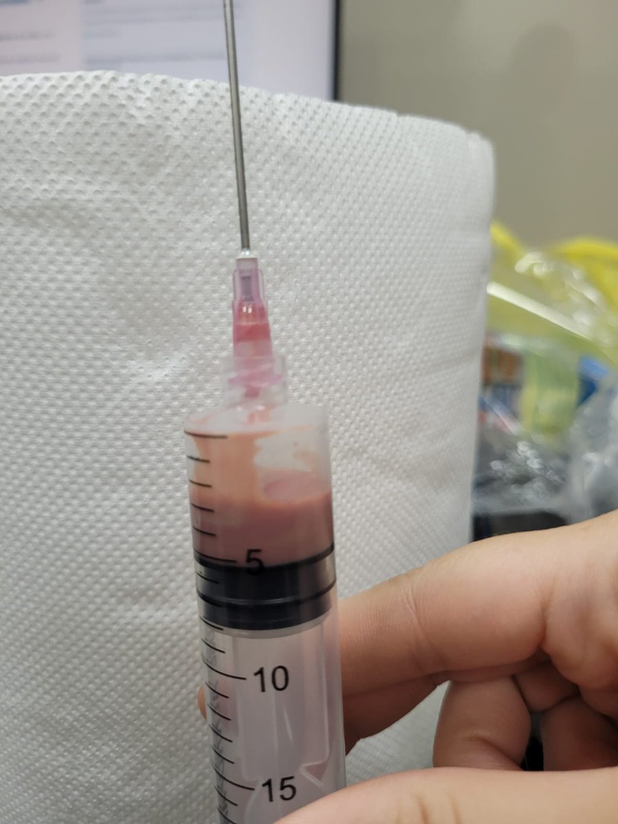 ConsejosReumato's tweet photo. Mujer con #lupus quien recibe #prednisona y #micofenolato , desarrolló #celulares del dorso del pie y #artritis de 1ra MTF, la #artrocentesis mostró LS turbio con gran cantidad de PMN, en el cultivo se aisló S. aureus; mejoró con antibióticos y drenaje quirúrgico.#podagra #sle https://t.co/ZPFJZeMntY