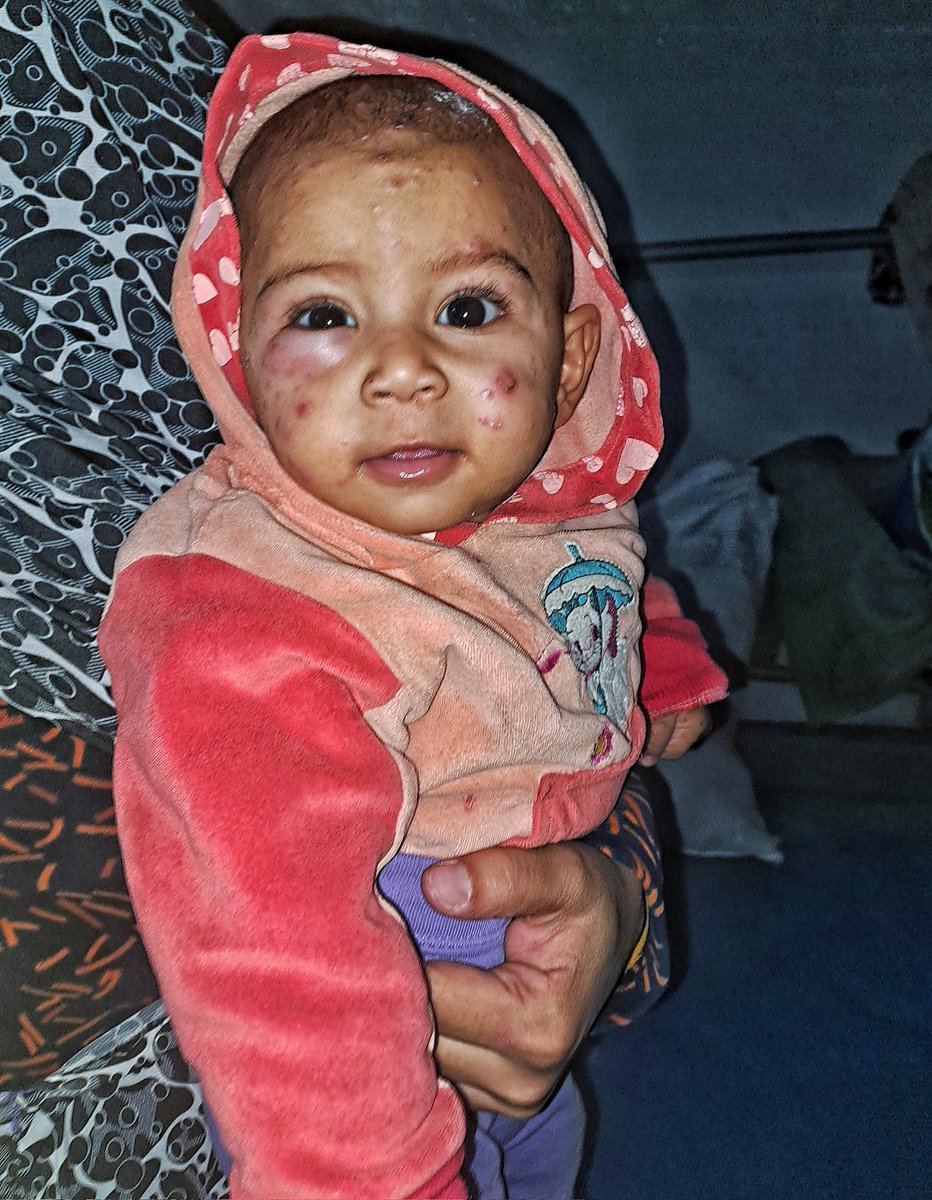 mahmoud60013's tweet photo. Don't ignore me please. Tasneem's eye is swelling up quickly, causing puffiness under her innocent eye. It causes her a lot of pain whenever she cries. Tasneem is crying and her eye is burning. Her body is full of pimples and spots. The weather is making her condition worse. Tasneem needs medicine to relieve her pain.
https://t.co/fo8V75E2AX