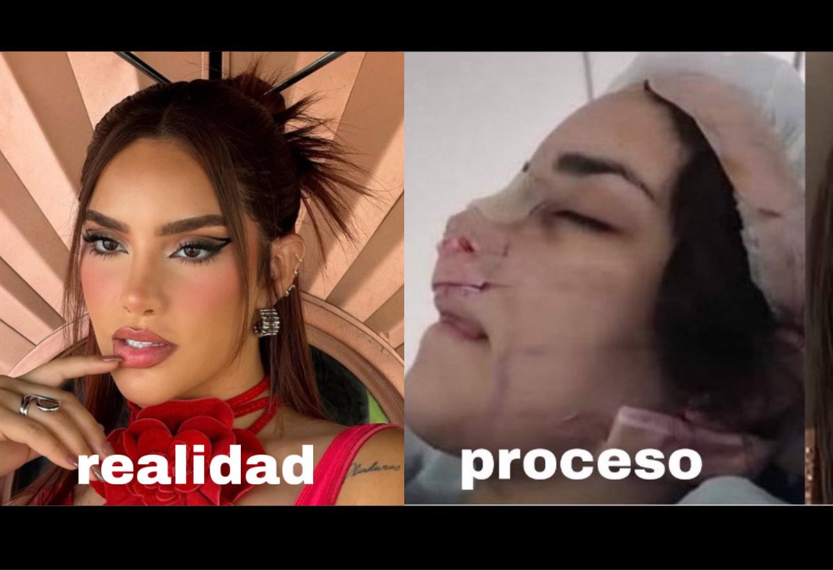 MERMUDITA's tweet photo. Hablemos de los procedimientos estéticos y operaciones que ha tenido @KimberlyLoaiza_ presumiendo de un cuerpo totalmente FALSO ante redes, además de burlarse del cuerpo de menores de edad. Exponiendo a Kim Loaiza; A thread https://t.co/d0H2sbQwcT