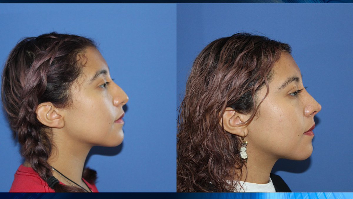 jesusgodinez's tweet photo. Rinoplastia, Resultados naturales Gracias por su confianza #doctorjesusgodinez, #cirugiafacialgodinez, #rinoplastiasegura, #rinoplastia, #resultadospermanentes, #elresultadoesindividual, https://t.co/hDZK0BcoXQ