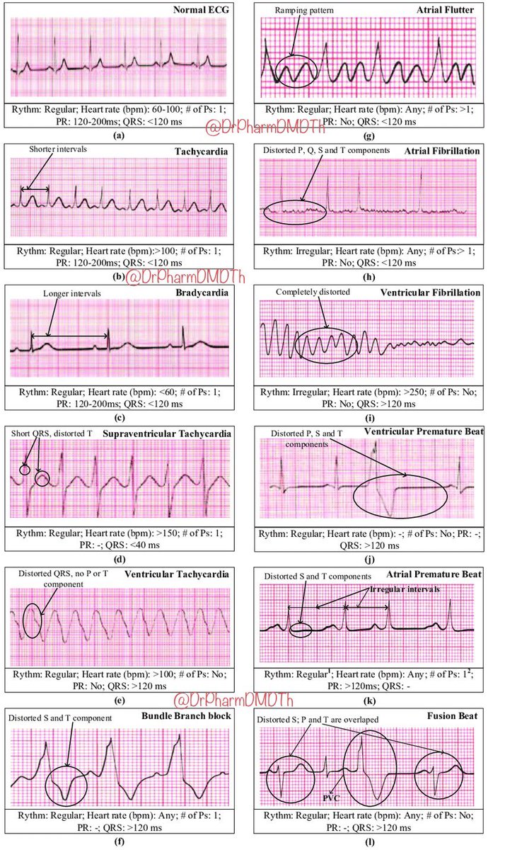 AB_drmd's tweet photo. خلنا نشرح اهم المشاكل اللي ممكن تمر عليك في ال ECG:

❤️‍🔥 القصة تبدأ بـ Normal ECG:
أول شيء نبدأ فيه هو "Normal ECG" – هذا القلب مرتاح، ينبض بنظام، ما فيه دراما.
الريذم: منتظم ✅
النبض: من 60 إلى 100 bpm
الـ PR interval: من 120 إلى 200 ms
الـ QRS: أقل من 120 ms
عدد الـ P waves = 1 قبل كل QRS → طبيعي جدًا 👌

🏃‍♂️ Tachycardia:
القلب قاعد يركض! الـ Tachycardia يعني سرعة ضربات القلب >100 bpm.
الريذم: منتظم
PR طبيعي
QRS طبيعي
كل P لها QRS لكن الفواصل أقصر لأن القلب مستعجل ⏩

🐢 Bradycardia:
القلب يمشي مشي بطّيء 🐢 أقل من 60 bpm.
الريذم: منتظم
PR طبيعي
QRS طبيعي
نفس عدد الـ P = QRS، بس الفراغات طويلة بين النبضات ⏳

🚀 Supraventricular Tachycardia:
هذي زي التاشيكارديا بس أشد وأسرع، فوق 150 bpm. تنبع من فوق البطينين (atria).
QRS قصير جدًا < 40ms 😮
الـ T wave مشوه
ما تقدر تشوف P بسهولة
القلب كأنه عالق على سبيد سريع جدًا!

💣 Ventricular Tachycardia:
هنا تبدأ الخطورة… القلب ينبض من البطين مباشرة، مو من الأذين.
مافيه P waves
QRS مشوه وكبير >120ms
كل ضربة شكلها غريب!
هذي حالة ممكن تتطور لـ Ventricular Fibrillation 💀

🔥 Ventricular Fibrillation:
هنا القلب ما ينبض… هو يرتعش بس! 😨
كله مشوه
مافيه P ولا QRS
مافيه رذم
النبض >250 (إذا حسبته أساسًا)
حالة خطرة جدًا وتحتاج CPR أو Defibrillator ⚡

🌀 Atrial Fibrillation:
هنا الأذين يرتعش مو البطين، عشان كذا QRS لسه ظاهر.
الريذم: غير منتظم
مافيه P واضحة
QRS طبيعي
تلاحظ ارتجاف خفيف بدل الـ P → atrial quivering
ممكن يسبب جلطة! 🧠

🦋 Atrial Flutter:
أشهر شكل فيها يسمونه Sawtooth pattern زي أسنان المنشار!
الريذم: منتظم
مافيه PR
أكثر من P wave قبل كل QRS
القلب يرسل إشارات كثيرة من الأذين لكن مش كلها توصل البطين.

⚡ Ventricular Premature Beat:
يجيك ضربة غريبة لحالها، خارجة عن السياق.
QRS مشوه
T مشوه
تجي فجأة في نص تخطيط طبيعي
غالبًا harmless بس تزعج المريض 😅

🚨 Atrial Premature Beat:
زي اللي فوق بس من الأذين. الضربة تيجي قبل وقتها وتشوّه شوي الـ T والـ P.
الـ intervals تصير غير منتظمة
تلاحظ إن شكل الـ P شوي مش طبيعي

💔 Bundle Branch Block:
لما واحد من فرعي التوصيل في البطين يوقف، يصير الـ QRS مشوه وكبير.
QRS >120ms
T مشوه
ممكن تلاحظ split في QRS

🧬 Fusion Beat:
لما ضربتين (واحدة من البطين وواحدة من الأذين) يصيروا بنفس الوقت، يندمجوا!
تلاحظ QRS غريب
تشوف أحيانًا PVC داخله على موجة عادية
الشكل مشوه شوي بس منتظم