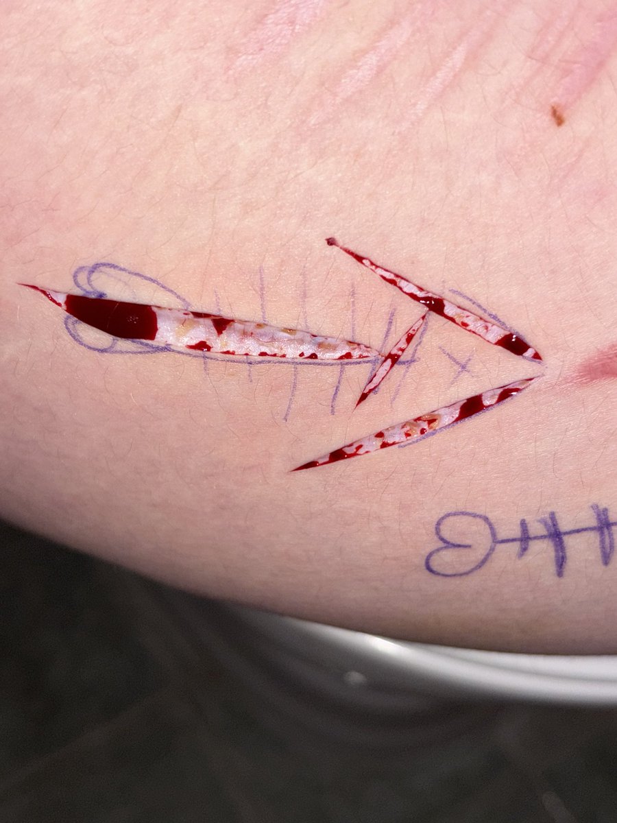 cheeeesy69's tweet photo. Tried to carve out a fishbone on the side of my thigh following the guidelines. Went so BAD. Gave up midway https://t.co/mosqahBT7x