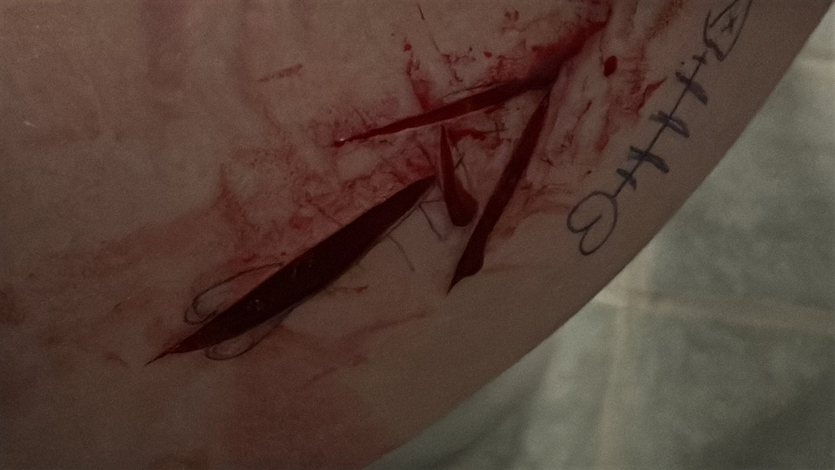 cheeeesy69's tweet photo. Tried to carve out a fishbone on the side of my thigh following the guidelines. Went so BAD. Gave up midway https://t.co/mosqahBT7x