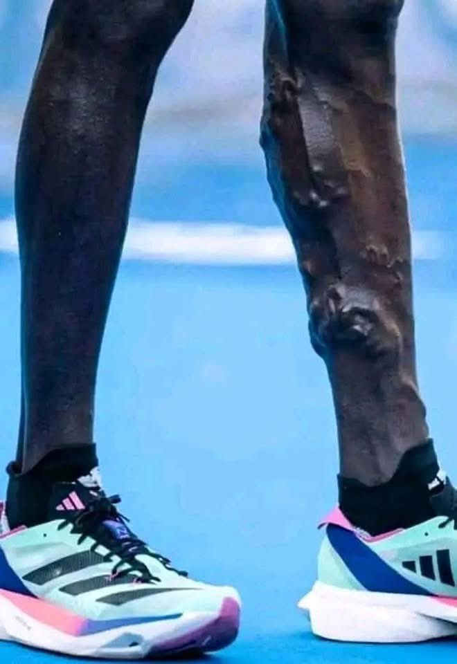 Joe__Bassey's tweet photo. The legs of Kenyan🇰🇪  athletes Victor Kipruto and Charles Matata after the 21k Zurich Rock 'n' Roll Running Series Madrid. They finished at positions 1 and 2. We appreciate our athletes. https://t.co/RmiFewzSRc