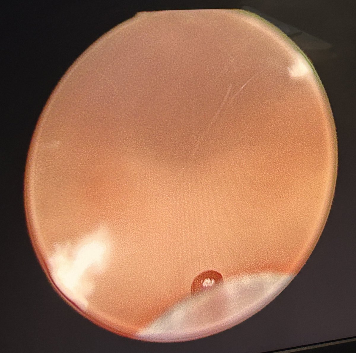 HoLEP after failed Optilume for BPH. The patient had multiple admissions and blood transfusions for intractable bleeding. Prostate was 54 cc preop. 33 grams removed along with 500 cc of clot from the bladder using the morcellator.