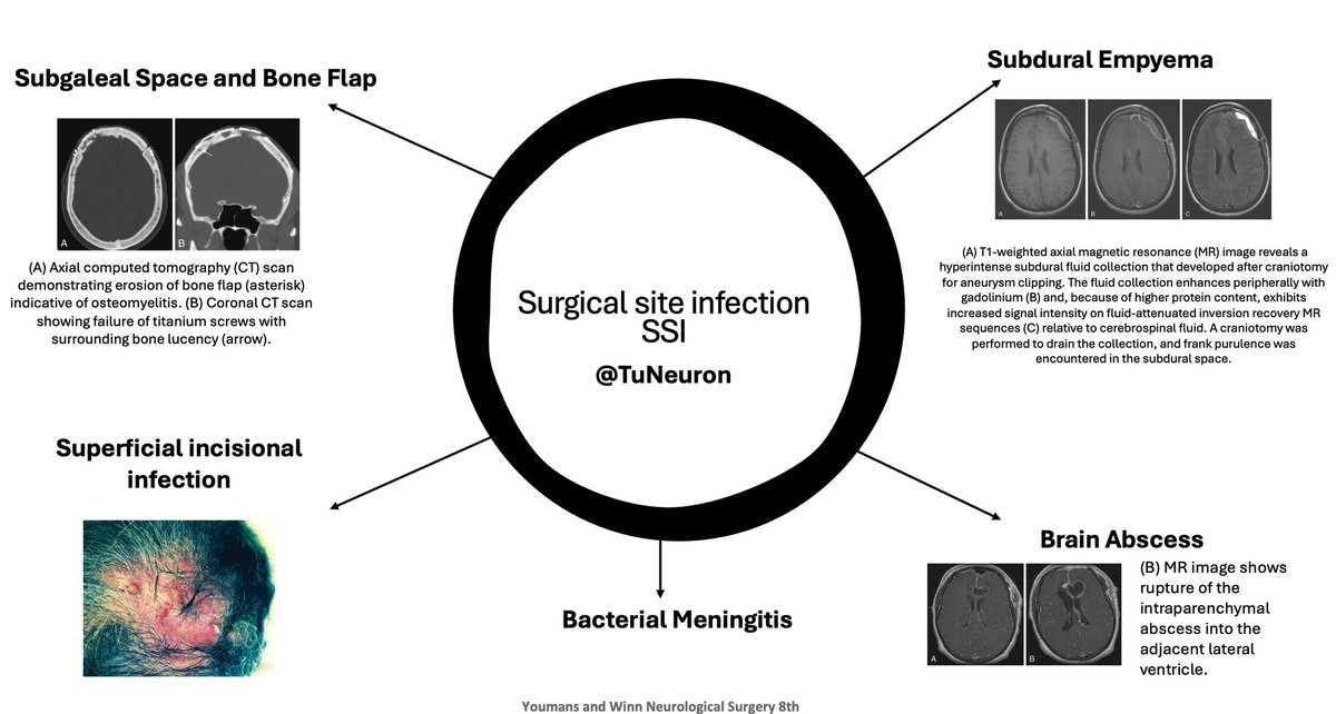 TuNeuron's tweet photo. Surgical site infection [SSI]; in neurosurgery 🧠🦠
In 4 slides🩻: https://t.co/8qdWgLTgdV