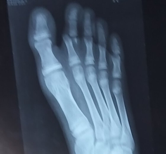 BMOdehufflepftt's tweet image. 🛑🛑🛑
We're overdue already and there still $3380 more to raise
This is urgently needed for both my mother's post-surgery tests -that are 2 months late- and my 15 yo brother's open fracture surgery
Please DONATE & SHARE 🙏 🙏 🙏
gofund.me/f2ee57c1