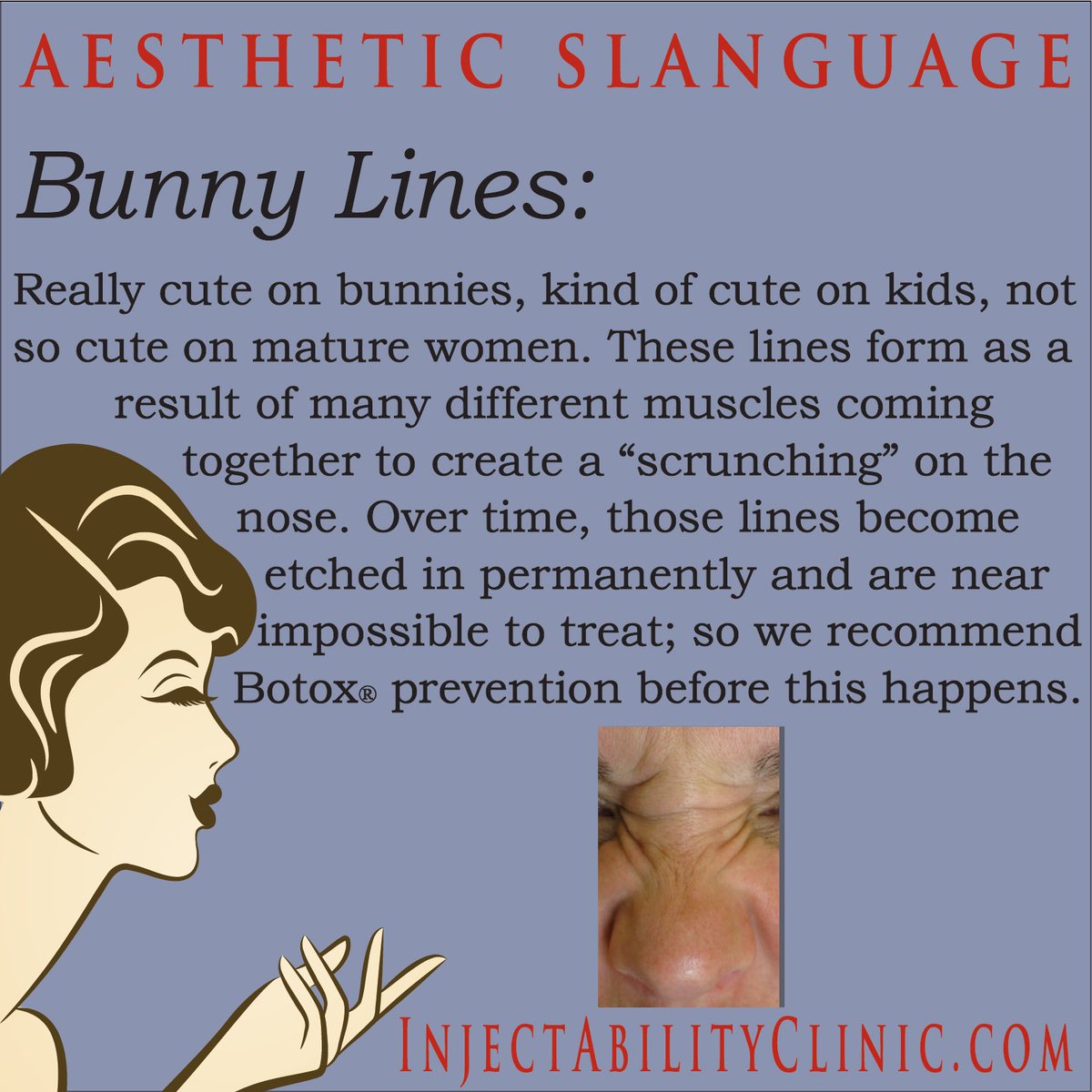 InjectAbility's tweet photo. Bunny Lines: Cute on bunnies, not so cute on us! 🐰 These fine lines on the sides of the nose form from repeated facial expressions and can become etched in over time. The good news? #Botox can help soften and even prevent them before they become permanent. https://t.co/n3LE3Nxv1I