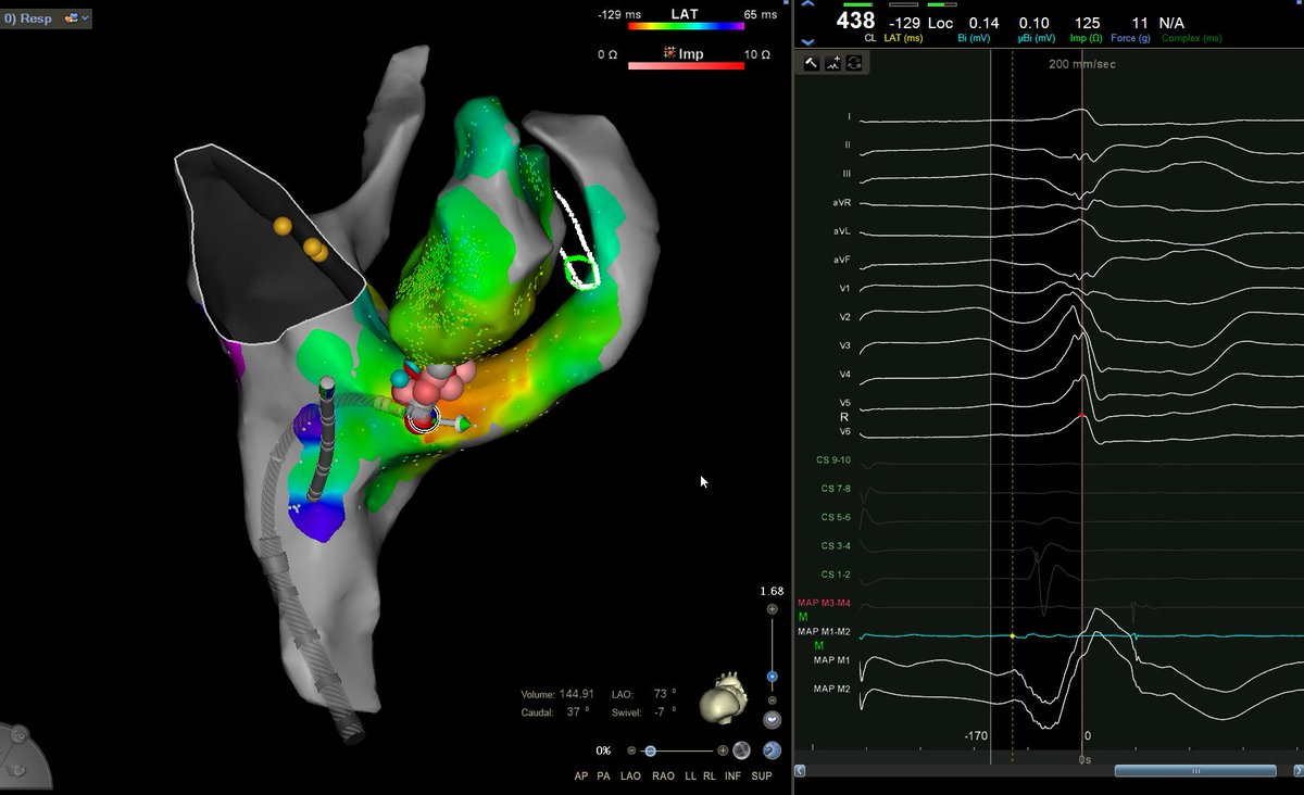 James Kneller, M.D., Ph.D., FHRS (@jamesknellermd) on Twitter photo When your posteroseptal LV #PVC is so basal you actually get it from the CS.
<a href="/uazmedphx/">UAZ Medicine - Phoenix</a> <a href="/uazphxcards/">UAZ Phoenix Cardiology</a> <a href="/uazresearch/">University of Arizona Research</a> <a href="/UAZHealth/">University of Arizona Health Sciences</a> @Epeeps_Bot #Epeeps #cardiotwitter
<a href="/EPTMArizonaLFG/">Shane Brian</a>
<a href="/JNJInnovation/">Johnson & Johnson Innovation</a> <a href="/JNJVision/">Johnson & Johnson | Vision</a> When your posteroseptal LV #PVC is so basal you actually get it from the CS.
<a href="/uazmedphx/">UAZ Medicine - Phoenix</a> <a href="/uazphxcards/">UAZ Phoenix Cardiology</a> <a href="/uazresearch/">University of Arizona Research</a> <a href="/UAZHealth/">University of Arizona Health Sciences</a> @Epeeps_Bot #Epeeps #cardiotwitter
<a href="/EPTMArizonaLFG/">Shane Brian</a>
<a href="/JNJInnovation/">Johnson & Johnson Innovation</a> <a href="/JNJVision/">Johnson & Johnson | Vision</a>
