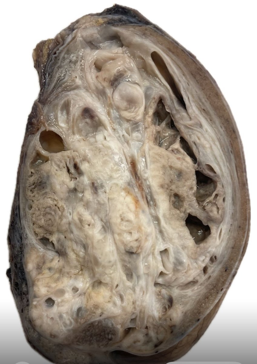 The art of grossing. A 26 yo old man with a left 5x4cm testicular tumor. Final Diagnosis. Mature Teratoma.#pathresidents #pathologists #PathTweeter #GUpath