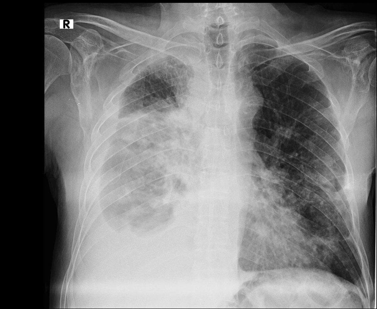 drchalocortez's tweet photo. #ayudandoadiagnosticar Derrame Pleural, correlación radiológica y control post drenaje. https://t.co/nCCtpsavsS