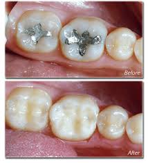 dentist_speaks's tweet photo. Silver fillings vs Composite fillings.

#Say_No to dental silver fillings as they continue to introduce mercury into the Oral environment (harmful aspect)..!

Meanwhile composite fillings are a popular and aesthetically pleasing choice.
#Dentistry #DentalFillings https://t.co/EaWz1E9O9w