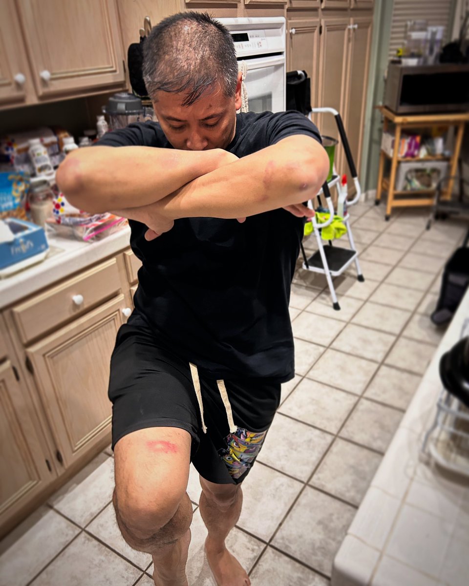 AkumaKaizen's tweet photo. A long time ago, I decided I wasn’t going to follow in my grandfather’s footsteps and come home bruised from fighting. Almost 25 years later I guess I threw that out. I do miss days like this.

#martialarts #fma #mma #sticks #stickfighting #bruises #aftermath #suckitup #training https://t.co/JvOYhtp4mi