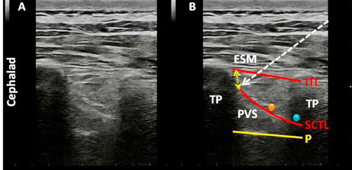 STIL  BLOCK (Subtranverse process interligamentary block)   pubmed.ncbi.nlm.nih.gov/31476624/