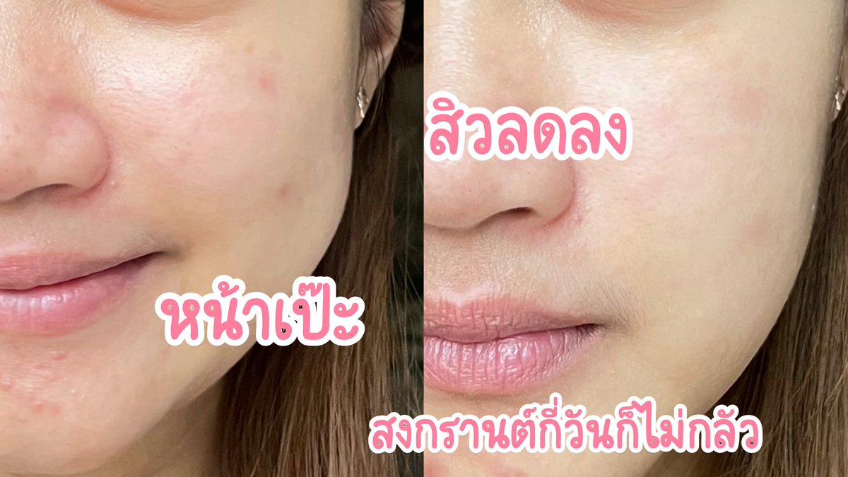 จัดมาจุกๆจ้าาา เจลลี่ลดสิว Jelly Me ZinC ตัวช่วยลดสิวหน้าใสขึ้น กินอร่อยกินง่ายด้วย หอมพีชสุดๆ เคี้ยวเพลิน แต่ไม่มีน้ำตาล กินละตัวไม่บวมแน่นอน พิกัด 7-11

#JellyMe #JellyMeCuti #ความคิวทิบิลด์ง่ายได้ทุกวัน #JellyMeZinc #ลดสิว #HowtoPerfect https://t.co/vu7iuZ0hBD