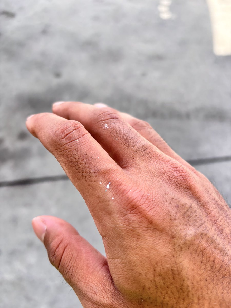 อุบัติเหตุ เกิดขึ้นได้ตลอดเวลา และที่สำคัญห้องพยาบาลลาแต่ติดป้ายว่าเข้าห้องน้ำ😂