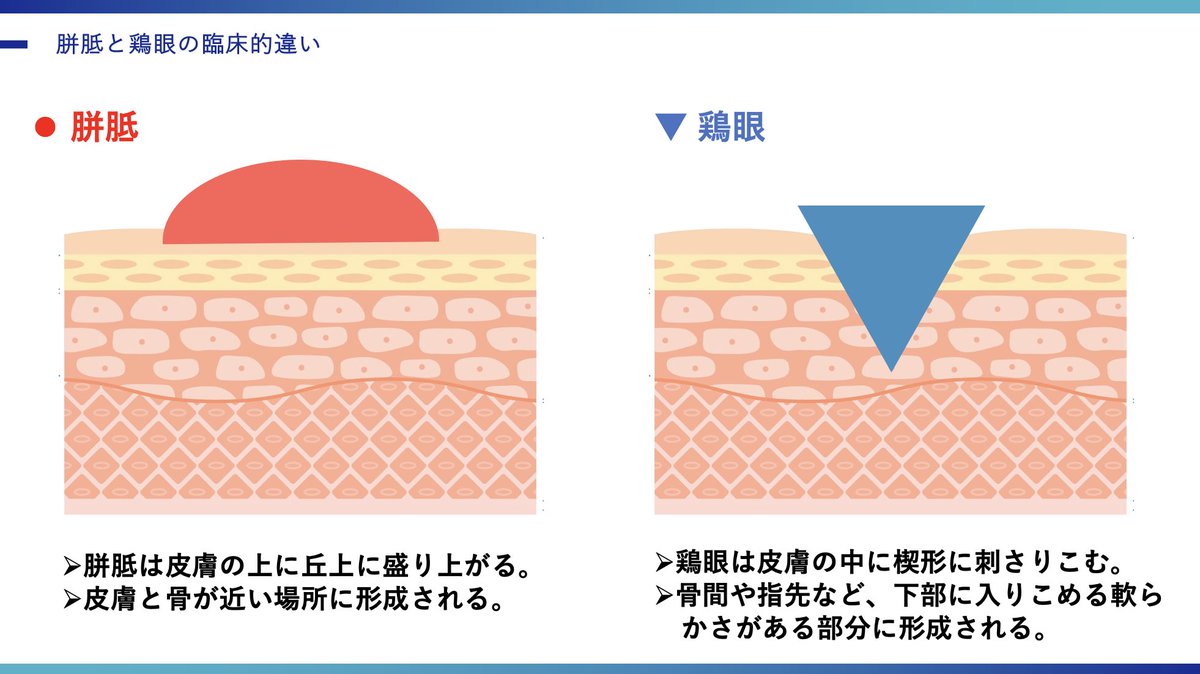 oshiroakito's tweet photo. 胼胝・鶏眼の基礎知識🦶

扁平足や外反母趾にほぼ確で
併発する胼胝・鶏眼（ウオノメ）。

ポイントは圧＋摩擦。

メカニカルストレスを可視化
できる貴重な臨床所見です🦶

#沖縄
#理学療法士
#胼胝は骨に近い部分に
#鶏眼は柔らかい部分に https://t.co/ToL3yOnzTo