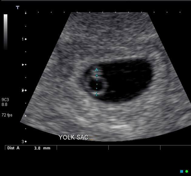 IhabFathiSulima's tweet photo. In a lady with #amenorrhea .
What does the #diamond 💎💍 #Ring sign indicates ? https://t.co/fD3Q9fY1NC