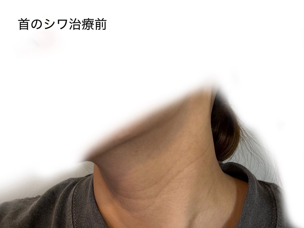 Yasagure_tokyo's tweet photo. ＼首の横ジワ治療レポ／
モフィウス8＋プロファイロ＋ミラクルHの合わせ技で挑んだ結果、結構シワ薄くなってない？？ https://t.co/OtFsADrLoe