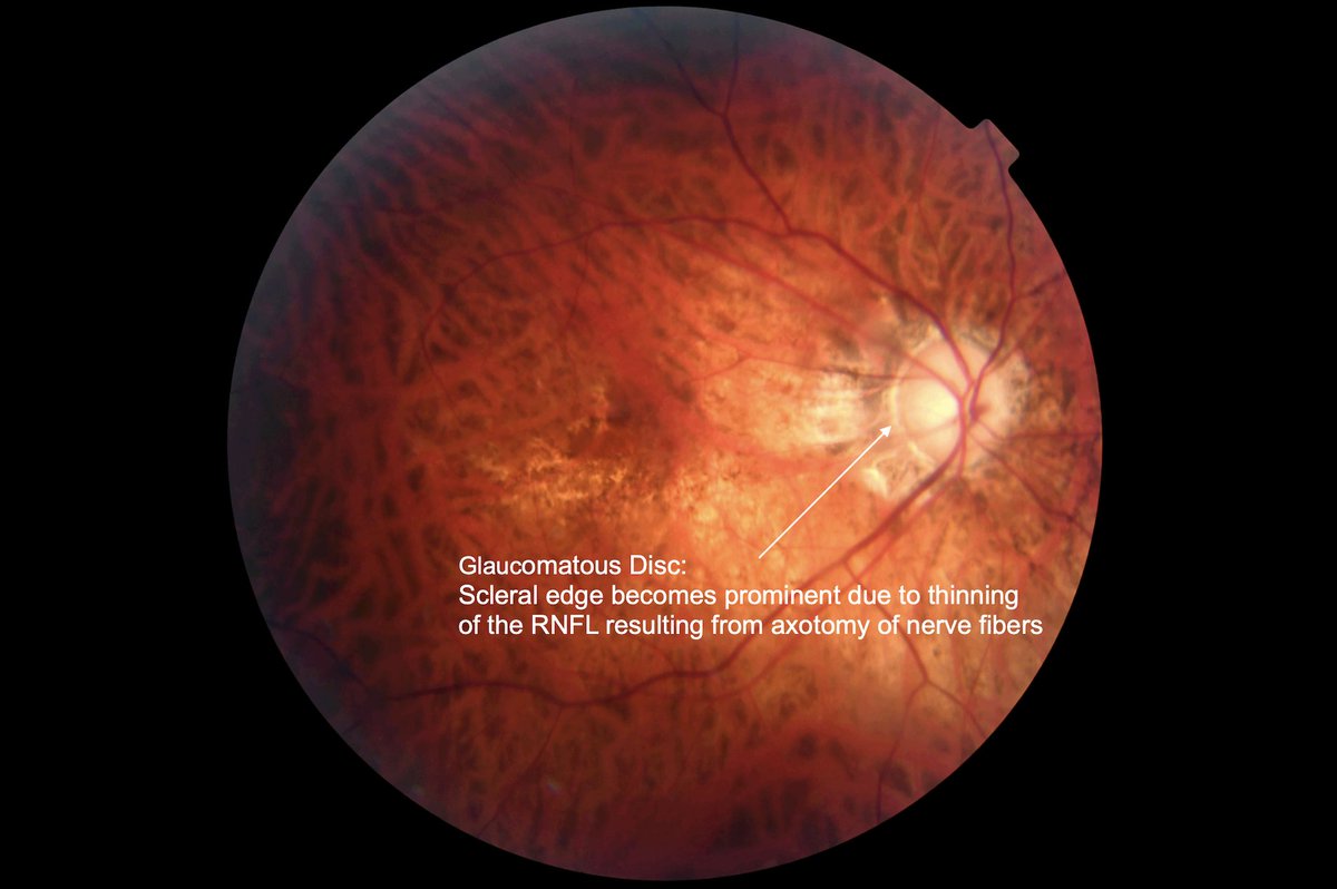 SyedHasnainMD's tweet photo. Right eye of 37 year-old male with advanced glaucoma.     

Notable observations:    

- Prominent scleral edge (Hasnain sign) due to thinning  of the retinal nerve fiber layer (RFNL), resulting from the AXOTOMY of nerve fibers.    

- Sinking of the entire lamina cribrosa resulting in stretching and the axotomy of nerve fibers at the scleral edge.      

- Absence of smaller vasculature (baldness) around the optic disc resulting from their severance (Hasnain sign).    

Bottom Line:  Chronic glaucoma may not be an optic neuropathy, but an optic disc axotomy #glaucoma #ophthalmology #optometry