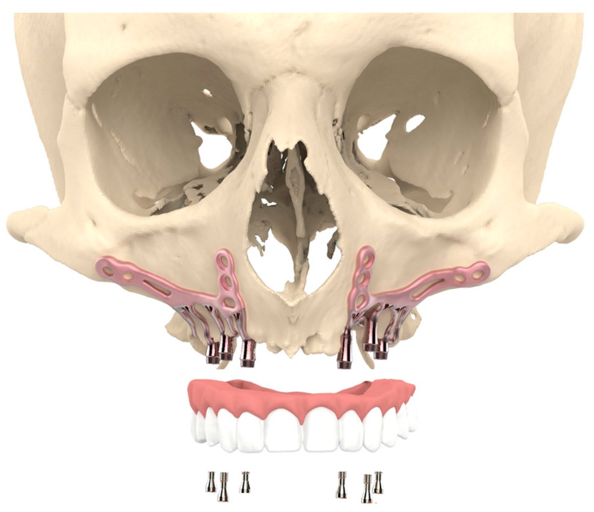 JPM_MDPI's tweet photo. #mdpijpm
๐ป "Patient Satisfaction and Impact on #Oral Health after #Maxillary Rehabilitation Using a Personalized Additively Manufactured Subperiosteal Jaw Implant (AMSJI)"
๐จโ๐ฌ Casper Van den Borre et al.
๐ซ Vrije Universiteit Brussel
๐ https://t.co/El3SM6D9Su https://t.co/H0zoa6ar1w