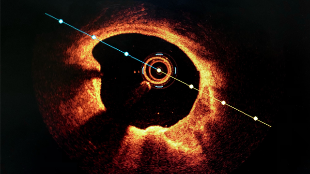 radcliffeCARDIO's tweet photo. 📚New #ICRJournal Article: "Coronary Calcification: Types, Morphology and Distribution"

📚 Just Published!

🔓Access it here 👉 https://t.co/ZKJUeHl2N3

 #CVImaging #MedEd #CardioEd https://t.co/6N6BHqPnKL