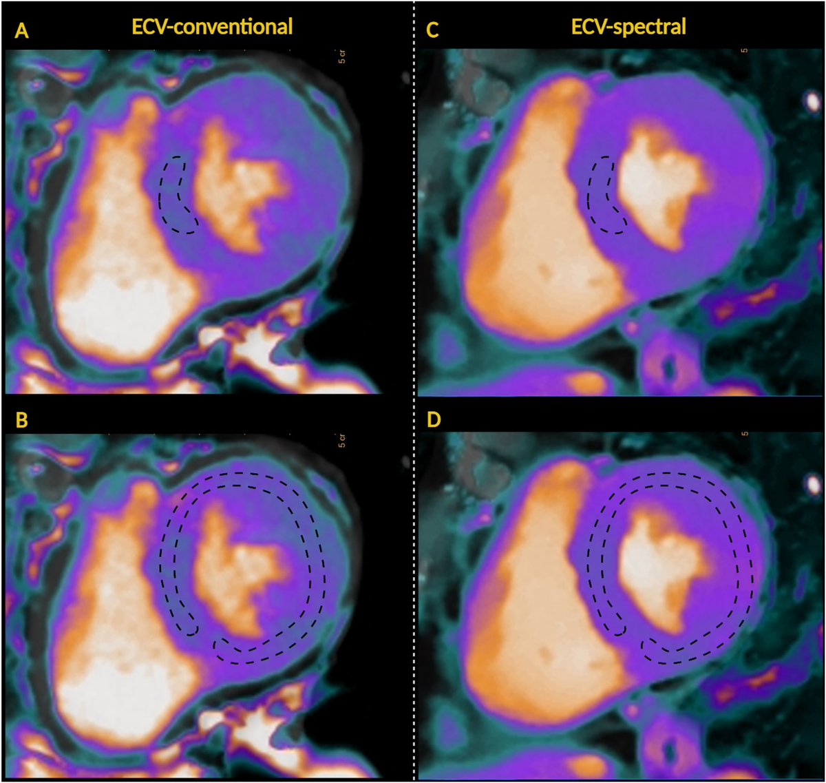 Leandro Slipczuk (@cardiomdphd) on Twitter photo Comparison of dual-energy iodine and standard subtraction methods for myocardial extracellular volume quantification using cardiac computed tomography
<a href="/danilorenzatti/">Daniel Lorenzatti, MD.</a> <a href="/analyzeF/">Annalisa Filtz</a> <a href="/pamelapina_s/">Pamela Piña S.</a> <a href="/JeirymMirandaMD/">Jeirym Miranda , MD✨</a> <a href="/Felipe94Y/">Felipe Contreras Y.</a> <a href="/AndreaScotti21/">Andrea Scotti</a> <a href="/JoaoLCavalcante/">João Cavalcante</a> <a href="/azeemlatib/">Azeem Latib</a>
<a href="/journalCCT/">Journal of Cardiovascular CT</a> Comparison of dual-energy iodine and standard subtraction methods for myocardial extracellular volume quantification using cardiac computed tomography
<a href="/danilorenzatti/">Daniel Lorenzatti, MD.</a> <a href="/analyzeF/">Annalisa Filtz</a> <a href="/pamelapina_s/">Pamela Piña S.</a> <a href="/JeirymMirandaMD/">Jeirym Miranda , MD✨</a> <a href="/Felipe94Y/">Felipe Contreras Y.</a> <a href="/AndreaScotti21/">Andrea Scotti</a> <a href="/JoaoLCavalcante/">João Cavalcante</a> <a href="/azeemlatib/">Azeem Latib</a>
<a href="/journalCCT/">Journal of Cardiovascular CT</a>