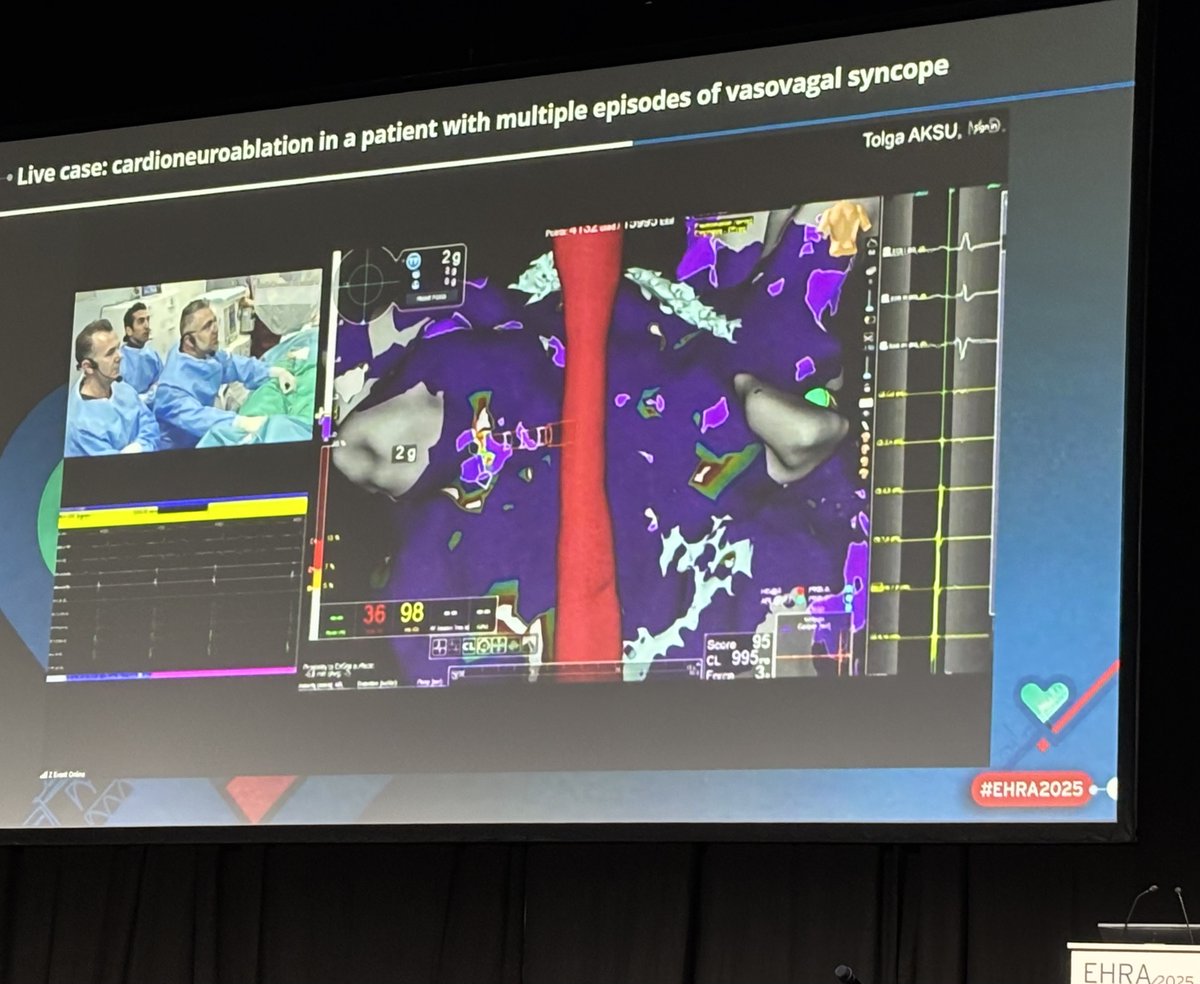inHEART (@inheartmedical) on Twitter photo Exciting news! Professor <a href="/MDTolgaAksu/">Tolga Aksu, MD</a>'s live case session from EHRA 2025 is now available to rewatch! Witness a real-time #CardioneuralAblation in a patient with recurrent vasovagal syncope, and see how #inHEART’s advanced 3D imaging technology can support your CNA procedures. Exciting news! Professor <a href="/MDTolgaAksu/">Tolga Aksu, MD</a>'s live case session from EHRA 2025 is now available to rewatch! Witness a real-time #CardioneuralAblation in a patient with recurrent vasovagal syncope, and see how #inHEART’s advanced 3D imaging technology can support your CNA procedures.
