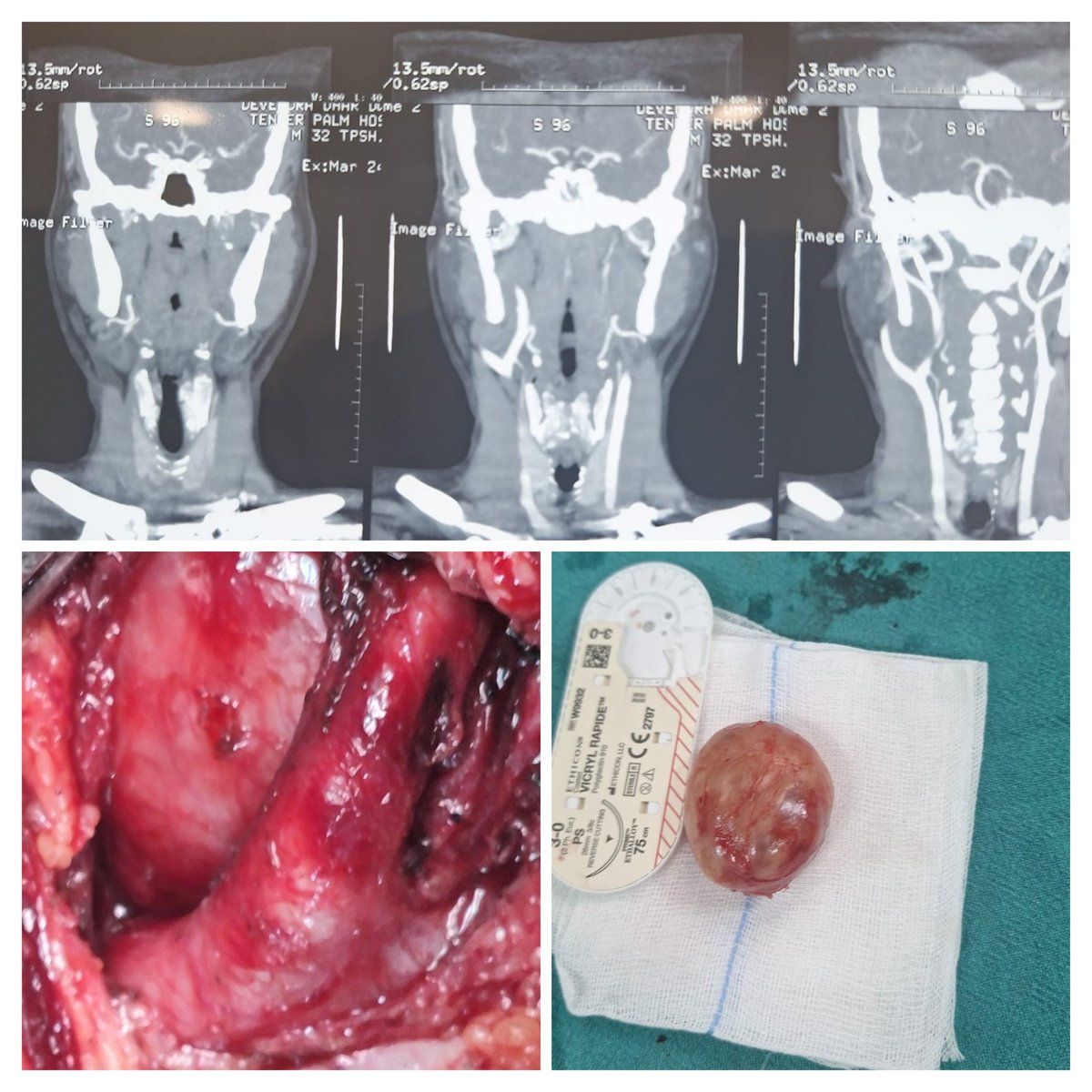 Ashutosh pandey (@vascularsrgn) on Twitter photo The silent carotid splay : A splayed carotid bifurcation with non-enhancement - eccentrically originating vagal schwannoma. Discharged without deficits.
Pt travelled 1000kms to get a vascular team operate this. <a href="/PShivanesandr/">DrPShivanesan</a> <a href="/pcvasc/">P C Gupta</a> <a href="/VascularForum/">Fórum Vascular</a> <a href="/wfvs/">jswf</a> <a href="/docpark/">W. Michael Park, MD</a> #medtwitter The silent carotid splay : A splayed carotid bifurcation with non-enhancement - eccentrically originating vagal schwannoma. Discharged without deficits.
Pt travelled 1000kms to get a vascular team operate this. <a href="/PShivanesandr/">DrPShivanesan</a> <a href="/pcvasc/">P C Gupta</a> <a href="/VascularForum/">Fórum Vascular</a> <a href="/wfvs/">jswf</a> <a href="/docpark/">W. Michael Park, MD</a> #medtwitter