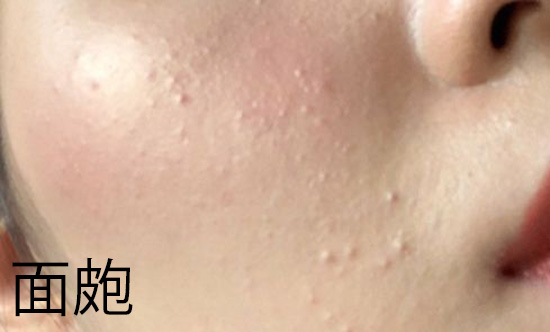 cocobeauty99's tweet photo. 閉鎖性面皰は基本的にクレンジング不足、角栓、皮脂の詰まりでできる。チキンスキン(毛孔性角化症)は毛穴自体の角化異常で角質が蓄積してできる🥺

治し方はコレ↓↓↓

🌟閉鎖性面皰
→白いぷつぷつ、ちょっとツルツル
◎アダパレン：閉鎖性面皰には特効薬レベルで皮膚科でもよく処方✨
〇アゼライン酸：抗炎症作用と角質を剥がす効果で閉鎖性面皰にも使える
〇サリチル酸：角質を柔らかくして毛穴の汚れを溶かす効果あり
※クレンジングちゃんとするのも超大事！

🌟毛孔性角化症(チキンスキン)
→ザラザラで鳥肌みたい🐔
◎アダパレン：毛穴の詰まりを改善！ザラザラ肌をスベスベに
〇アゼライン酸：毛穴詰まりや肌のザラつきをマイルドに改善
△尿素クリーム：角質を柔らかくしつつ保湿もできる
△サリチル酸：毛孔性角化症には効果が限定的
※毛孔性角化症はアダパレンで角質をリセットしつつ保湿が大事！

ザラザラしてる、痛くない、メイクのりが悪い…それ、チキンスキンの可能性大⚠️どっちもアダパレンとアゼライン酸で治せる。迷ったらまず「アダパレン週2から」始めて、様子見て「アゼライン酸」足すと失敗しにくい🌟サリチル酸は補助的に使う感じでOK！