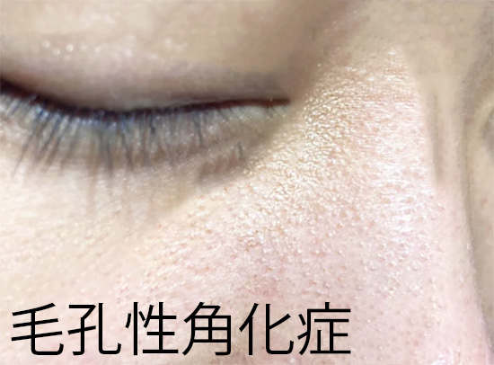 cocobeauty99's tweet photo. 閉鎖性面皰は基本的にクレンジング不足、角栓、皮脂の詰まりでできる。チキンスキン(毛孔性角化症)は毛穴自体の角化異常で角質が蓄積してできる🥺

治し方はコレ↓↓↓

🌟閉鎖性面皰
→白いぷつぷつ、ちょっとツルツル
◎アダパレン：閉鎖性面皰には特効薬レベルで皮膚科でもよく処方✨
〇アゼライン酸：抗炎症作用と角質を剥がす効果で閉鎖性面皰にも使える
〇サリチル酸：角質を柔らかくして毛穴の汚れを溶かす効果あり
※クレンジングちゃんとするのも超大事！

🌟毛孔性角化症(チキンスキン)
→ザラザラで鳥肌みたい🐔
◎アダパレン：毛穴の詰まりを改善！ザラザラ肌をスベスベに
〇アゼライン酸：毛穴詰まりや肌のザラつきをマイルドに改善
△尿素クリーム：角質を柔らかくしつつ保湿もできる
△サリチル酸：毛孔性角化症には効果が限定的
※毛孔性角化症はアダパレンで角質をリセットしつつ保湿が大事！

ザラザラしてる、痛くない、メイクのりが悪い…それ、チキンスキンの可能性大⚠️どっちもアダパレンとアゼライン酸で治せる。迷ったらまず「アダパレン週2から」始めて、様子見て「アゼライン酸」足すと失敗しにくい🌟サリチル酸は補助的に使う感じでOK！